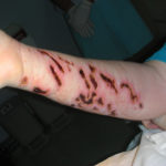 cara mengatasi sengatan ubur-ubur