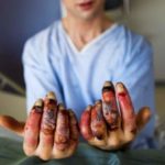 bahaya dan cara mengatasi frostbite